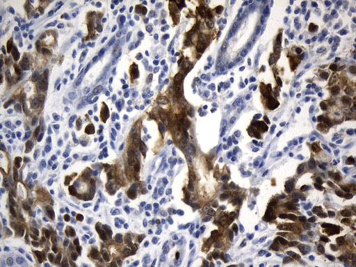 VIL1 / Villin Antibody - Immunohistochemical staining of paraffin-embedded Human Gastric Carcinoma using anti-VIL1. (Villin) mouse monoclonal antibody. (Heat-induced epitope retrieval by 1mM EDTA in 10mM Tris buffer. (pH8.5) at 120°C for 3 min(1:1000)