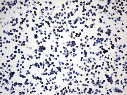VIL1 / Villin Antibody - Immunohistochemical staining of paraffin-embedded LoVo cell pellets using anti-VIL1. (Villin) mouse monoclonal antibody. (Heat-induced epitope retrieval by 1mM EDTA in 10mM Tris buffer. (pH8.0) at 120°C for 2.5 min. (1:1000)
