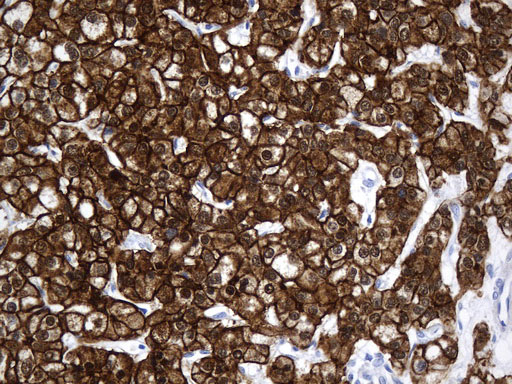 VIL1 / Villin Antibody - Immunohistochemical staining of paraffin-embedded Carcinoma of Human liver tissue using anti-VIL1. (Villin) mouse monoclonal antibody. (Heat-induced epitope retrieval by 1mM EDTA in 10mM Tris buffer. (pH8.5) at 120°C for 3 min. (1:1000)