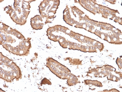 VIL1 / Villin Antibody - Formalin-fixed, paraffin-embedded human Small Intestinal Carcinoma stained with Villin Mouse Recombinant Monoclonal Antibody (rVIL1/1325).