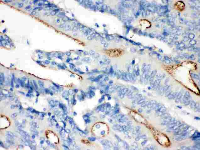 VIL1 / Villin Antibody - anti-Villin Picoband antibodyIHC(P): Human Intestinal Cancer Tissue