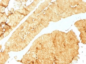 VIL1 / Villin Antibody - IHC testing of FFPE human colon with Villin antibody (clone VIL1/1325). Required HIER: boil tissue sections in 10mM citrate buffer, pH 6, for 10-20 min followed by cooling at RT for 20 min.