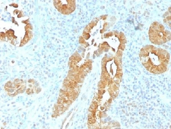 VIL1 / Villin Antibody - IHC testing of FFPE human rectum tissue with Villin antibody (clone VIL1/1325). Required HIER: boil tissue sections in 10mM citrate buffer, pH 6, for 10-20 min followed by cooling at RT for 20 min.