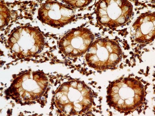 VIL1 / Villin Antibody - Fig-2: Immunohistochemical analysis of Villin in Colon Adenocarsinoma tissue using Villin antibody at 5 µg/ml.