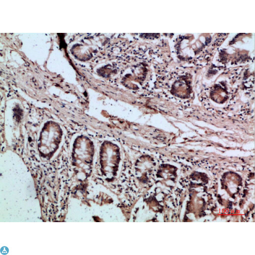 VIL1 / Villin Antibody - Immunohistochemical analysis of paraffin-embedded human-colon, antibody was diluted at 1:200.
