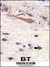 VILIP / VSNL1 Antibody - Formalin-fixed and paraffin-embedded human brain tissue reacted with VILIP1 antibody (C-term ), which was peroxidase-conjugated to the secondary antibody, followed by DAB staining. This data demonstrates the use of this antibody for immunohistochemistry; clinical relevance has not been evaluated.