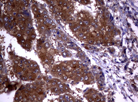 VILIP / VSNL1 Antibody - IHC of paraffin-embedded Carcinoma of Human liver tissue using anti-VSNL1 mouse monoclonal antibody. (Heat-induced epitope retrieval by 10mM citric buffer, pH6.0, 120°C for 3min).