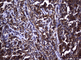 VILIP / VSNL1 Antibody - IHC of paraffin-embedded Human lymphoma tissue using anti-VSNL1 mouse monoclonal antibody. (Heat-induced epitope retrieval by 10mM citric buffer, pH6.0, 120°C for 3min).
