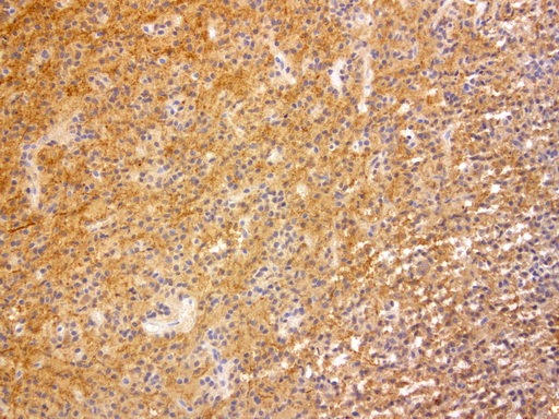 VILIP / VSNL1 Antibody - Immunohistochemical staining of paraffin-embedded human glioma using anti-VSNL1 clone UMAB115 mouse monoclonal antibody  at 1:200 with Polink2 Broad HRP DAB detection kit; heat-induced epitope retrieval with GBI Citrate pH6.0 HIER buffer using p