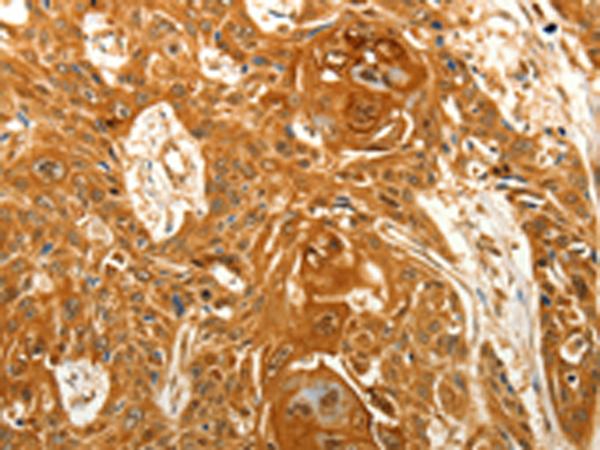 VILIP / VSNL1 Antibody - Immunohistochemistry of paraffin-embedded Human esophagus cancer tissue  using VSNL1 Polyclonal Antibody at dilution of 1:25(×200)
