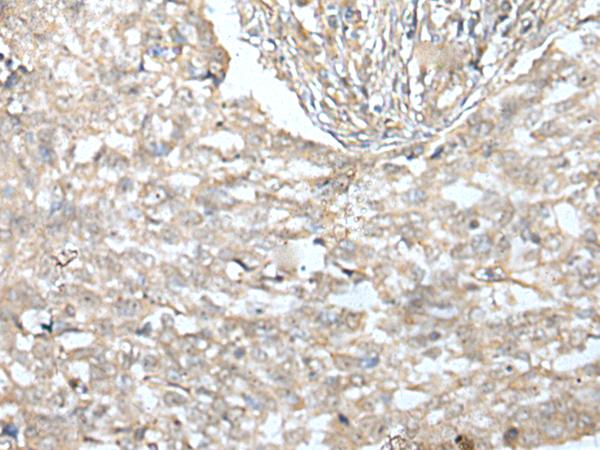 Villin-Like / VILL Antibody - Immunohistochemistry of paraffin-embedded Human lung cancer tissue  using VILL Polyclonal Antibody at dilution of 1:65(×200)