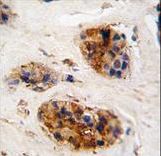 Vimentin Antibody - Formalin-fixed and paraffin-embedded human breast carcinoma tissue reacted with Vimentin antibody , which was peroxidase-conjugated to the secondary antibody, followed by DAB staining. This data demonstrates the use of this antibody for immunohistochemistry; clinical relevance has not been evaluated.