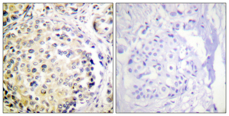 Vimentin Antibody - Immunohistochemistry analysis of paraffin-embedded human breast carcinoma tissue, using Vimentin Antibody. The picture on the right is blocked with the synthesized peptide.