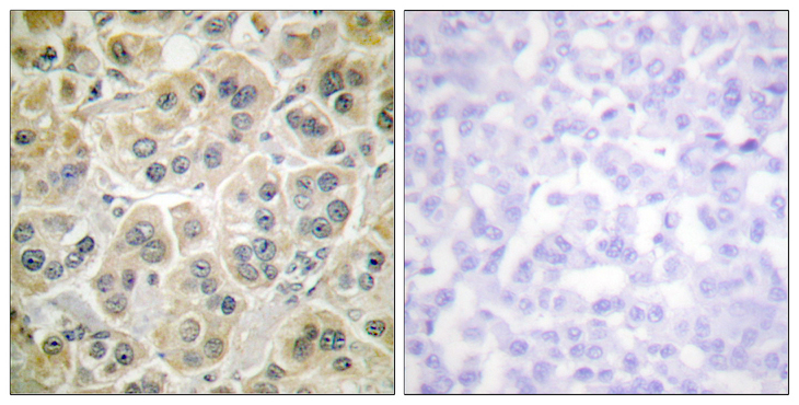 Vimentin Antibody - Immunohistochemistry analysis of paraffin-embedded human breast carcinoma tissue, using Vimentin Antibody. The picture on the right is blocked with the synthesized peptide.