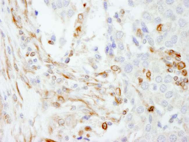 Vimentin Antibody - Detection of Human Vimentin by Immunohistochemistry. Sample: FFPE section of human breast carcinoma. Antibody: Affinity purified rabbit anti-Vimentin used at a dilution of 1:200 (1 ug/ml). Detection: DAB.