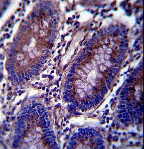 Vimentin Antibody - Vimentin Antibody immunohistochemistry of formalin-fixed and paraffin-embedded human colon tissue followed by peroxidase-conjugated secondary antibody and DAB staining.