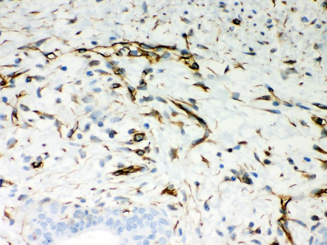 Vimentin Antibody - Vimentin antibody IHC-paraffin: Human Mammary Cancer Tissue.