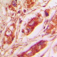 Vimentin Antibody - Immunohistochemical analysis of Vimentin staining in human lung cancer formalin fixed paraffin embedded tissue section. The section was pre-treated using heat mediated antigen retrieval with sodium citrate buffer (pH 6.0). The section was then incubated with the antibody at room temperature and detected using an HRP conjugated compact polymer system. DAB was used as the chromogen. The section was then counterstained with hematoxylin and mounted with DPX.