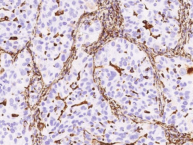Vimentin Antibody - Immunochemical staining of human Vimentin in human lung cancer with rabbit monoclonal antibody at 1:10000 dilution, formalin-fixed paraffin embedded sections.