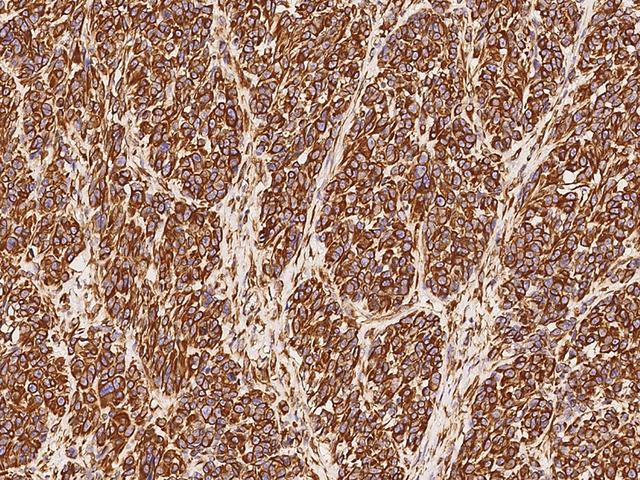 Vimentin Antibody - Immunochemical staining of human Vimentin in human malignant melanoma with rabbit monoclonal antibody at 1:10000 dilution, formalin-fixed paraffin embedded sections.