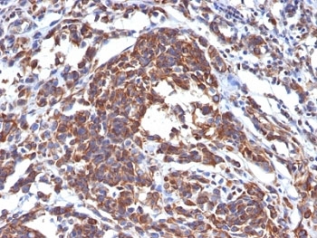 Vimentin Antibody - Formalin-fixed, paraffin-embedded human melanoma stained with Vimentin antibody (LN-6).  This image was taken for the unmodified form of this product. Other forms have not been tested.