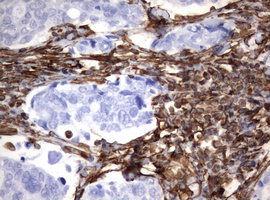 Vimentin Antibody - IHC of paraffin-embedded Adenocarcinoma of Human breast tissue using anti-VIM mouse monoclonal antibody. (Heat-induced epitope retrieval by 10mM citric buffer, pH6.0, 120°C for 3min).
