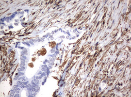 Vimentin Antibody - IHC of paraffin-embedded Adenocarcinoma of Human colon tissue using anti-VIM mouse monoclonal antibody. (Heat-induced epitope retrieval by 10mM citric buffer, pH6.0, 120°C for 3min).
