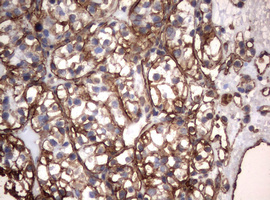 Vimentin Antibody - IHC of paraffin-embedded Carcinoma of Human kidney tissue using anti-VIM mouse monoclonal antibody. (Heat-induced epitope retrieval by 10mM citric buffer, pH6.0, 120°C for 3min).