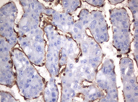 Vimentin Antibody - IHC of paraffin-embedded Carcinoma of Human liver tissue using anti-VIM mouse monoclonal antibody. (Heat-induced epitope retrieval by 10mM citric buffer, pH6.0, 120°C for 3min).