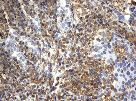 Vimentin Antibody - IHC of paraffin-embedded Carcinoma of Human lung tissue using anti-VIM mouse monoclonal antibody. (Heat-induced epitope retrieval by 10mM citric buffer, pH6.0, 120°C for 3min).