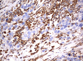 Vimentin Antibody - IHC of paraffin-embedded Adenocarcinoma of Human ovary tissue using anti-VIM mouse monoclonal antibody. (Heat-induced epitope retrieval by 10mM citric buffer, pH6.0, 120°C for 3min).