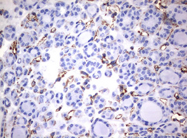 Vimentin Antibody - IHC of paraffin-embedded Carcinoma of Human thyroid tissue using anti-VIM mouse monoclonal antibody. (Heat-induced epitope retrieval by 10mM citric buffer, pH6.0, 120°C for 3min).