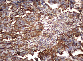 Vimentin Antibody - IHC of paraffin-embedded Adenocarcinoma of Human endometrium tissue using anti-VIM mouse monoclonal antibody. (Heat-induced epitope retrieval by 10mM citric buffer, pH6.0, 120°C for 3min).