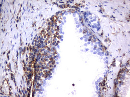 Vimentin Antibody - IHC of paraffin-embedded Carcinoma of Human prostate tissue using anti-VIM mouse monoclonal antibody. (Heat-induced epitope retrieval by 10mM citric buffer, pH6.0, 120°C for 3min).