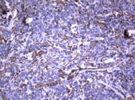 Vimentin Antibody - IHC of paraffin-embedded Human lymphoma tissue using anti-VIM mouse monoclonal antibody. (Heat-induced epitope retrieval by 10mM citric buffer, pH6.0, 120°C for 3min).