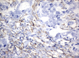 Vimentin Antibody - IHC of paraffin-embedded Adenocarcinoma of Human breast tissue using anti-VIM mouse monoclonal antibody.