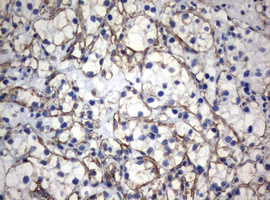 Vimentin Antibody - IHC of paraffin-embedded Carcinoma of Human kidney tissue using anti-VIM mouse monoclonal antibody.
