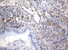 Vimentin Antibody - IHC of paraffin-embedded Carcinoma of Human lung tissue using anti-VIM mouse monoclonal antibody.