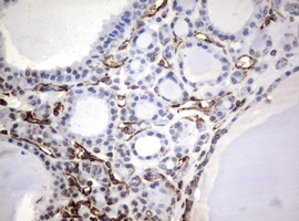 Vimentin Antibody - IHC of paraffin-embedded Carcinoma of Human thyroid tissue using anti-VIM mouse monoclonal antibody.