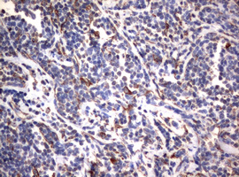 Vimentin Antibody - IHC of paraffin-embedded Human lymphoma tissue using anti-VIM mouse monoclonal antibody.
