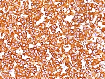 Vimentin Antibody - Formalin-fixed, paraffin-embedded human melanoma stained with VIM antibody (SPM576).  This image was taken for the unmodified form of this product. Other forms have not been tested.