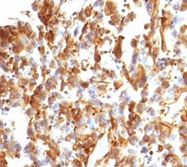 Vimentin Antibody - FFPE human melanoma stained with Vimentin antibody (VIM66-1).  This image was taken for the unmodified form of this product. Other forms have not been tested.