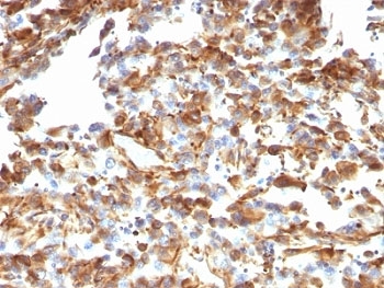 Vimentin Antibody - Formalin-fixed, paraffin-embedded human melanoma stained with anti-Vimentin antibody (VM1170).  This image was taken for the unmodified form of this product. Other forms have not been tested.