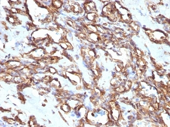 Vimentin Antibody - Formalin-fixed, paraffin-embedded human angiosarcoma stained with anti-Vimentin antibody (VM1170).  This image was taken for the unmodified form of this product. Other forms have not been tested.