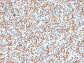 Vimentin Antibody - Formalin-fixed, paraffin-embedded human Ewing's sarcoma stained with anti-Vimentin antibody (VM1170).  This image was taken for the unmodified form of this product. Other forms have not been tested.