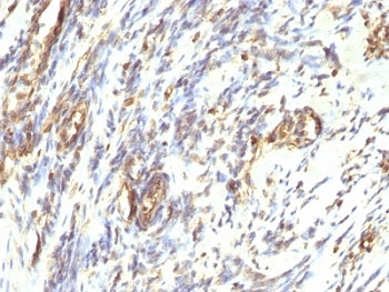 Vimentin Antibody - Formalin-fixed, paraffin-embedded human Leiomyosarcoma stained with anti-Vimentin antibody.  This image was taken for the unmodified form of this product. Other forms have not been tested.