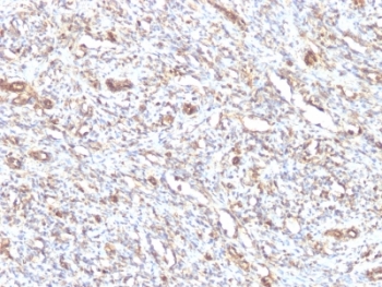 Vimentin Antibody - Formalin-fixed, paraffin-embedded human Rhabdomyosarcoma stained with anti-Vimentin antibody.  This image was taken for the unmodified form of this product. Other forms have not been tested.