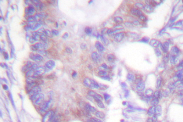 Vimentin Antibody - IHC of Vimentin (I444) pAb in paraffin-embedded human colon carcinoma tissue.