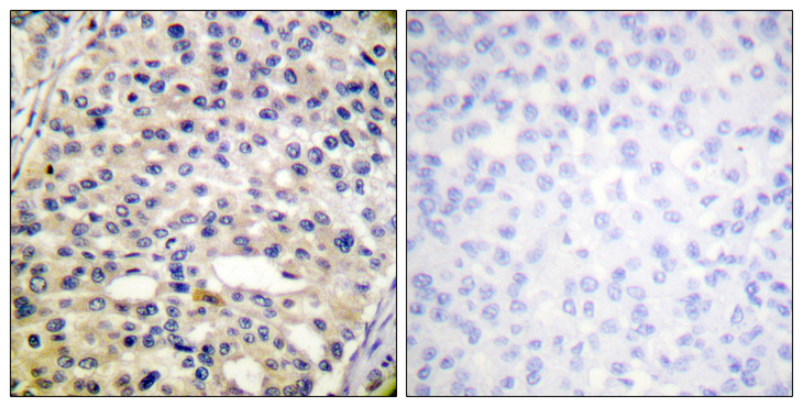 Vimentin Antibody - Immunohistochemistry analysis of paraffin-embedded human breast carcinoma, using Vimentin (Phospho-Ser56) Antibody. The picture on the right is blocked with the phospho peptide.