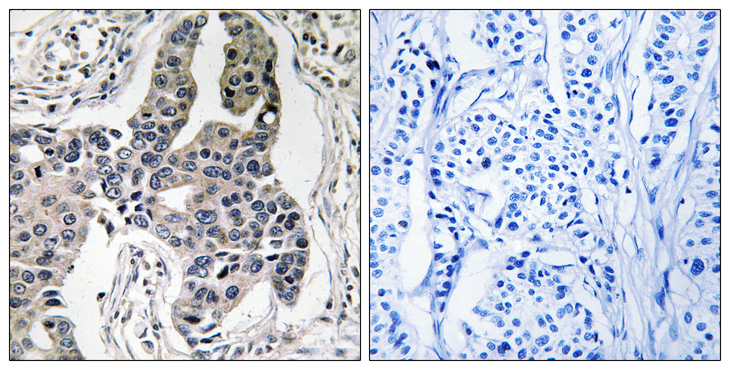 Vimentin Antibody - Immunohistochemistry analysis of paraffin-embedded human breast carcinoma, using Vimentin (Phospho-Ser83) Antibody. The picture on the right is blocked with the phospho peptide.